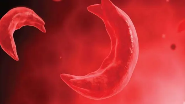 65000-people-to-be-examined-under-statewide-campaign-to-eradicate-sickle-cell-disease-by-gujarat-govt